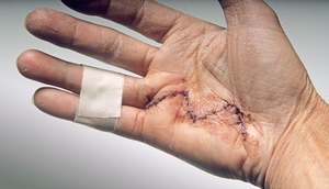Рука после операции для контрактура
